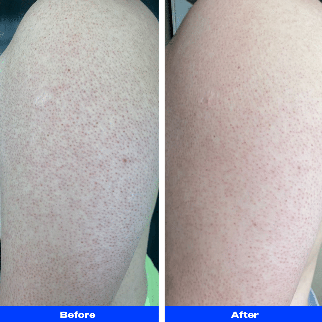 Double Exfoliator (Body Exfoliator x2)