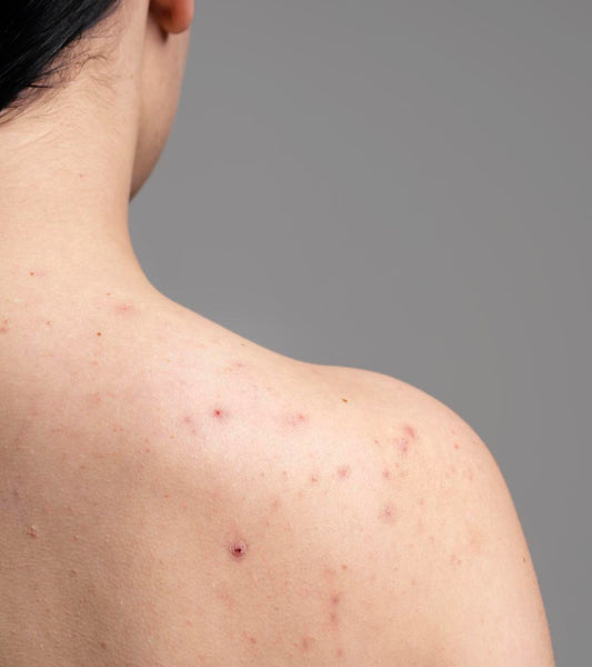 The benefits of using exfoliating gloves on back acne.