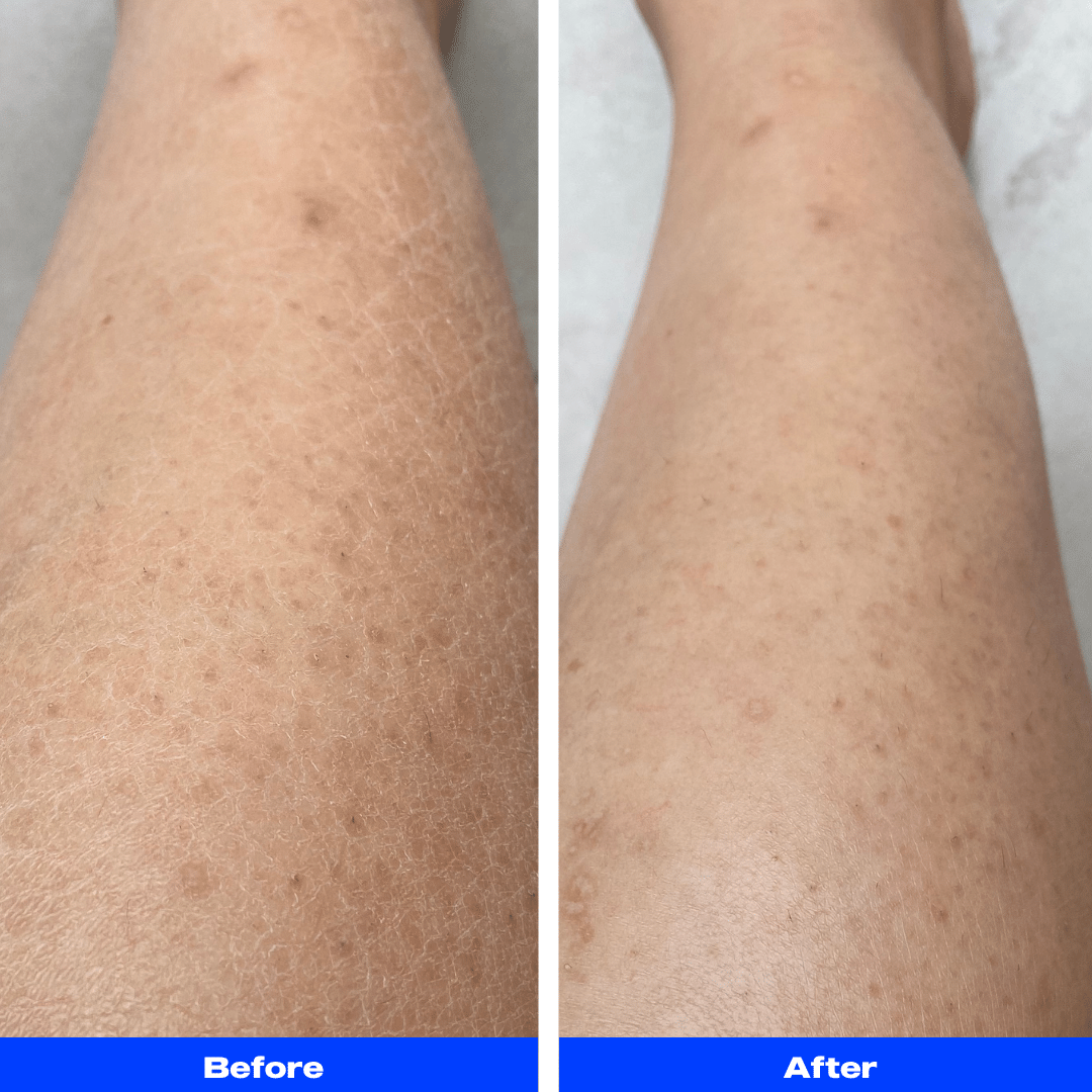 gentle reminder exfoliating glove fry & uneven skin tone before after
